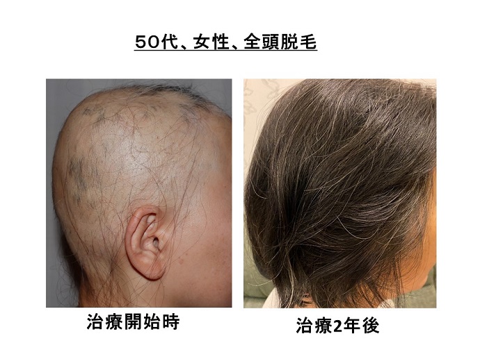 汎発性脱毛　病院